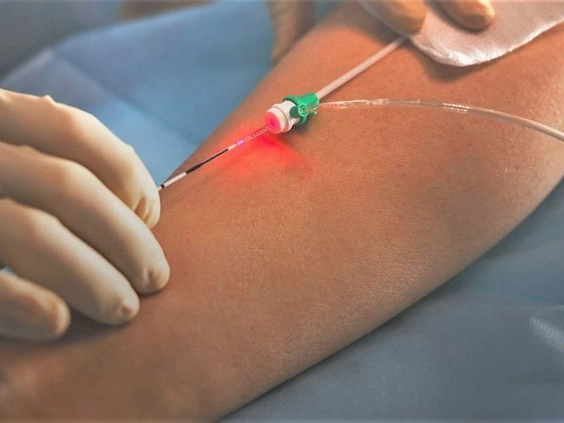 Endolaser