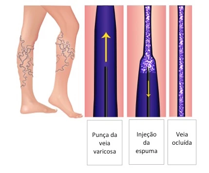 Espuma Densa — imagem 2